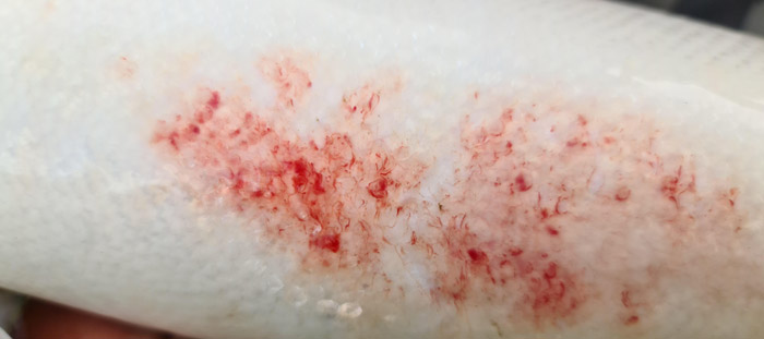 Laks med red skin disease lignende symptomer